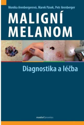 Malign&iacute; melanom &ndash; diagnostika a l&eacute;čba