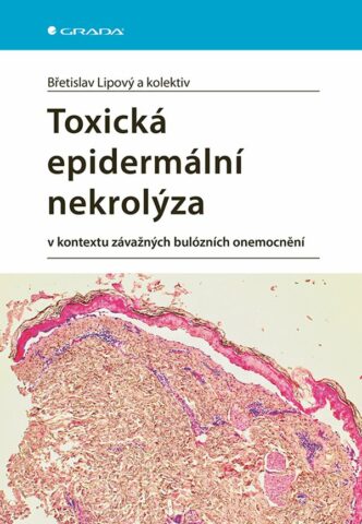 Toxick&aacute; epiderm&aacute;ln&iacute; nekrol&yacute;za v kontextu z&aacute;važn&yacute;ch bul&oacute;zn&iacute;ch onemocněn&iacute;